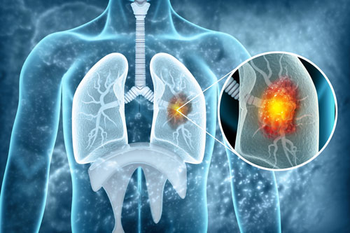 How Lung Tumors Hijack Nerves to Dodge the Immune System