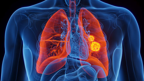 The Role of Regulatory T Cells in the Fight against Lung Cancer